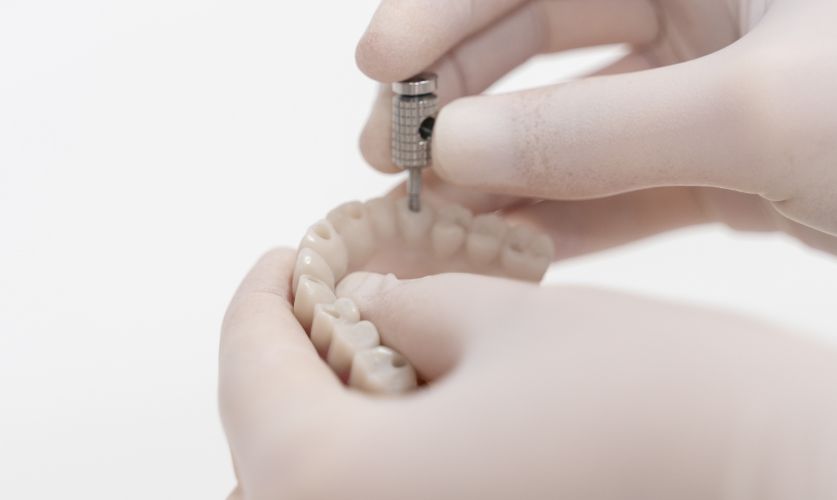 Técnicas de implantes All On Four en Valencia