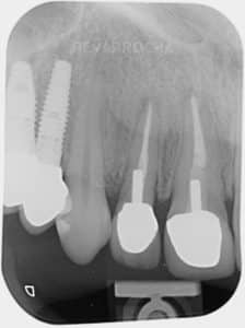 antes implante dental unitario implantes en un dia idim clinica de implantes dentales en valencia