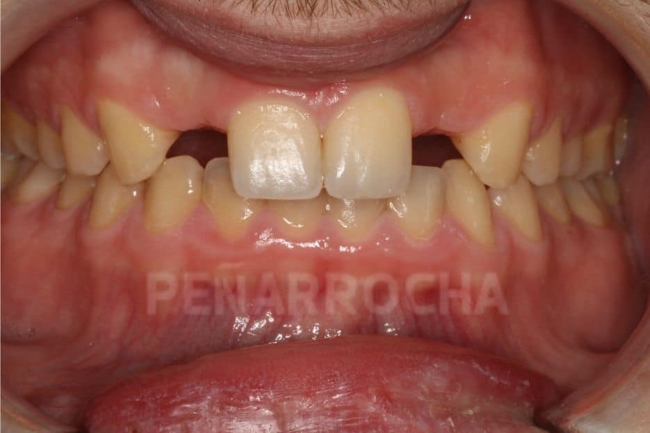 antes implantes parciales implantes en un dia IDIM clinica de implantes dentales en valencia