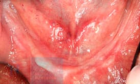 caso paciente antes implantes subperiosticos IDIM clinica de implantes dentales en valencia