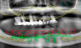 caso paciente radiografia antes implantes subperiosticos IDIM clinica de implantes dentales en valencia
