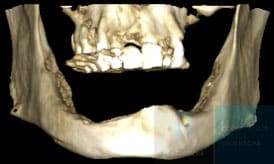 caso paciente antes de implantes subperiosticos IDIM clinica de implantes dentales en valencia