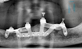 caso paciente despues implantes subperiosticos IDIM clinica de implantes dentales en valencia