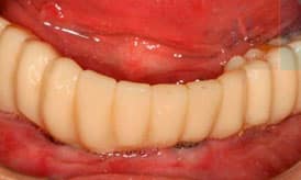 caso paciente despues implantes subperiosticos o yuxtaoseos IDIM clinica de implantes dentales en valencia