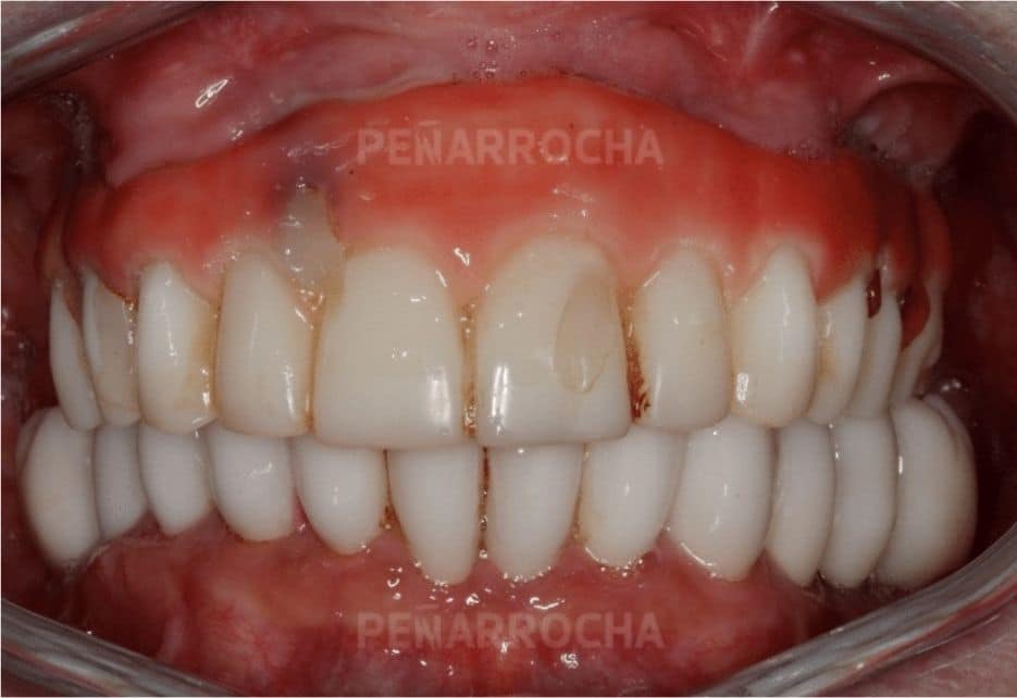 casos-de-exito-implantes-sin-hueso-idim-clinica-de-implantes-dentales-en-valencia casos de exito 1 implantes sin hueso idim clinica de implantes dentales en valencia