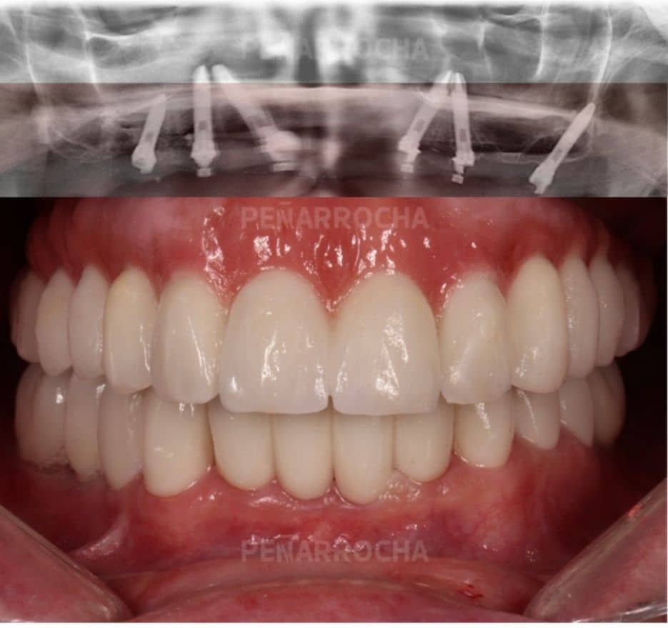 casos-de-exito-implantes-sin-hueso-idim-clinica-de-implantes-dentales-en-valencia casos de exito 2 implantes sin hueso idim clinica de implantes dentales en valencia
