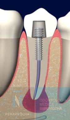 cirugia periapical tratamiento propuesto segunda opinion sobre endodoncia en valencia idim clinica de implantes dentales en valencia
