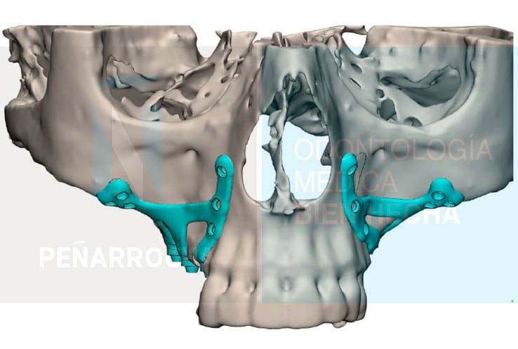 colocacion de los implantes subperiosticos idim clinica de implantes dentales en valencia