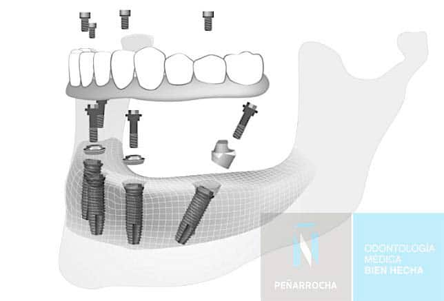 como se realiza el tratamiento implantes all on four en valencia idim clinica de implantes dentales en valencia
