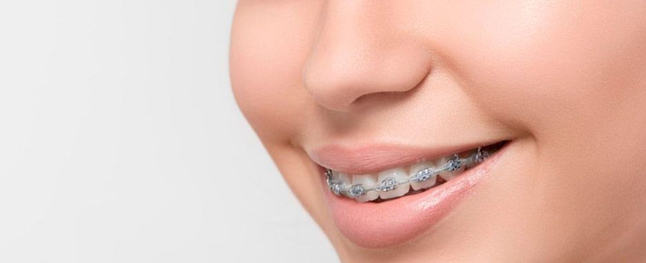 cual es la dieta ideal durante los primeros dias con brackets
