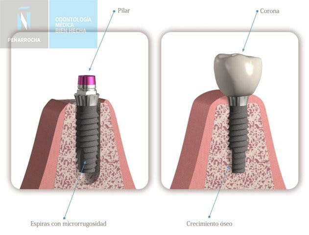 cuando se pueden colocar implantes inmediatos idim clinica de implantes dentales en valencia