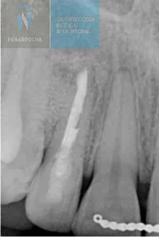 curacion radiografia tratamiento apical endodoncia mal hecha idim clinica de implantes dentales en valencia 