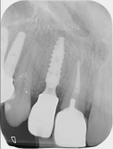 despues implante dental unitario implantes en un dia idim clinica de implantes dentales en valencia