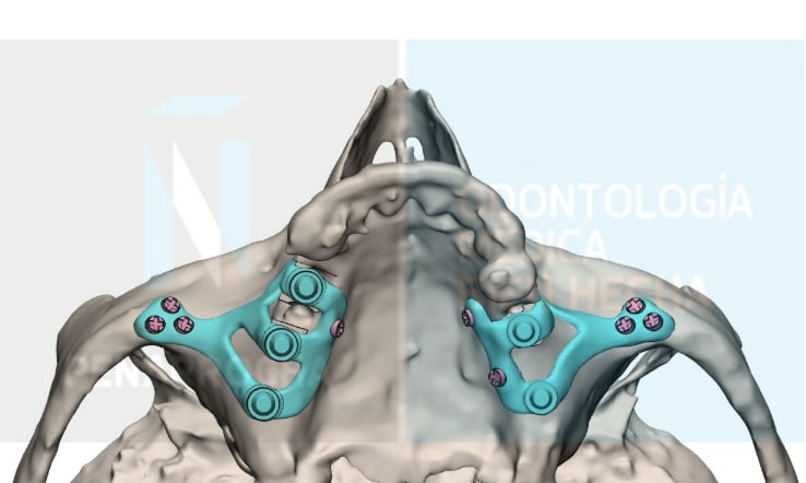 diseno implantes subperiosticos implantes dentales sin tornillos idim clinica de implantes dentales en valencia
