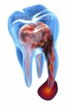 dolor implante poner un implante dental duele cuanto duelen los implantes dentales