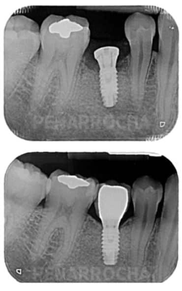 dolor implantes poner un implante dental duele