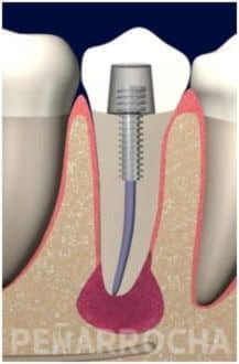 dolor implantes dentales poner un implante dental duele consejos para prevenir molestias implantes dentales
