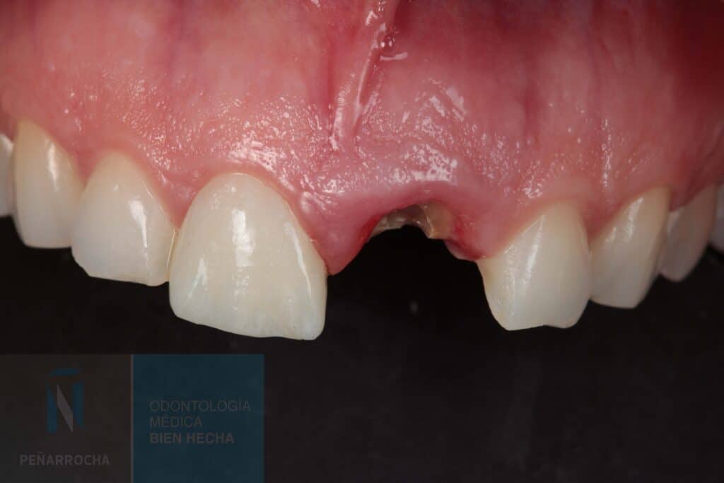 ejemplo antes implantes inmediatos idim clinica de implantes dentales en valencia