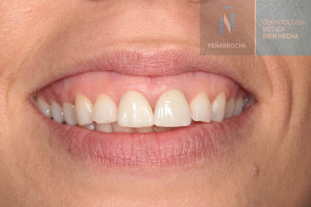 ejemplo despues implantes inmediatos idim clinica de implantes dentales en valencia