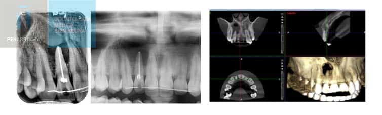 ejemplo radiografia segunda opinion sobre endodoncia en valencia idim clinica de implantes dentales en valencia