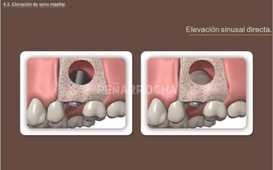 elevacion-de-seno-directa-tratamiento-implantes-sin-hueso-idim-clinica-de-implantes-dentales-en-valencia elevacion de seno directa tratamiento implantes sin hueso idim clinica de implantes dentales en valencia