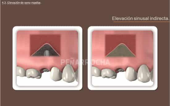 elevacion-de-seno-indirecta-tratamiento-implantes-sin-hueso-idim-clinica-de-implantes-dentales-en-valencia elevacion de seno indirecta tratamiento implantes sin hueso idim clinica de implantes dentales en valencia