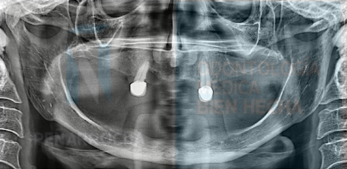 escaner atrofia osea avanzada paciente implantes dentales sin tornillos idim clinica de implantes dentales en valencia