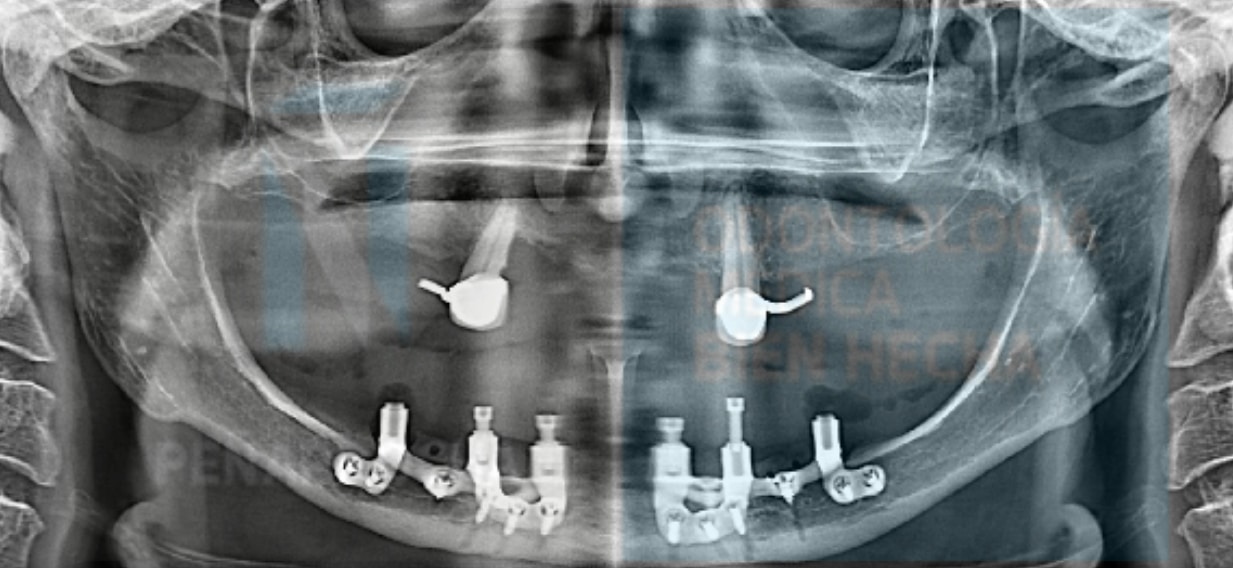 escaner resultado paciente implantes dentales sin tornillos idim clinica de implantes dentales en valencia