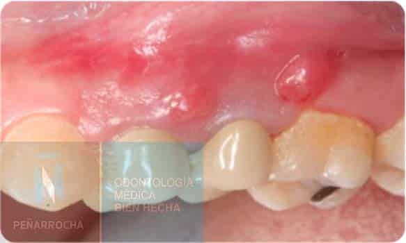 fistula sintomas endodoncia mal hecha idim clinica de implantes dentales en valencia 