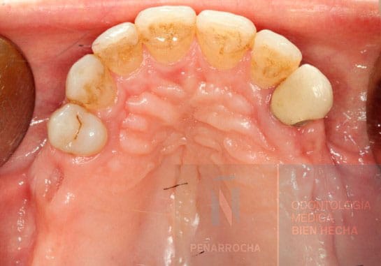 flujo de trabajo previo a implantes subperiosticos idim clinica de implantes dentales en valencia