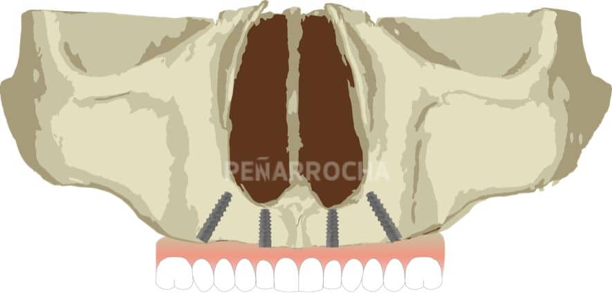 implantes all on four tecnica idim clinica de implantes dentales en valencia