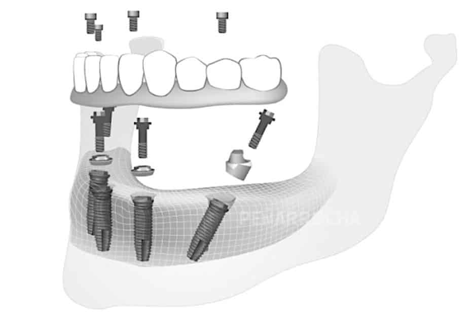 implantes-all-on-four-tecnica-implantes-sin-hueso-idim-clinica-de-implantes-dentales-en-valencia implantes all on four tecnica implantes sin hueso idim clinica de implantes dentales en valencia