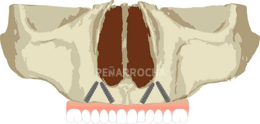 implantes angulados con implantes all on four en valencia IDIM clinica de implantes dentales en valencia