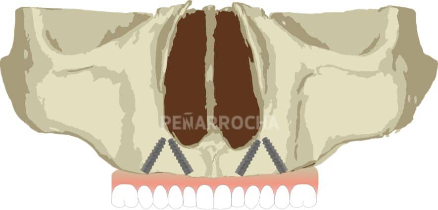 implantes-angulados-tecnica-implantes-sin-hueso-idim-clinica-de-implantes-dentales-en-valencia implantes angulados tecnica implantes sin hueso idim clinica de implantes dentales en valencia
