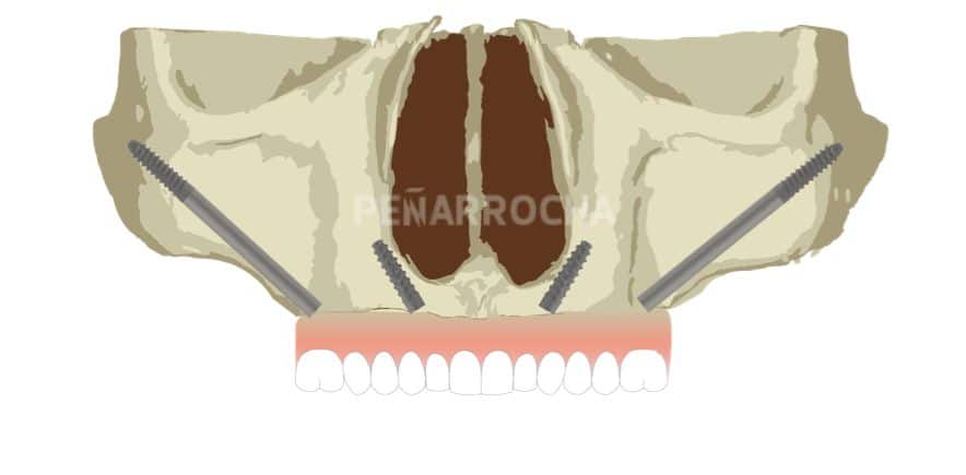 implantes-cigomaticos-1-tratamiento-implantes-sin-hueso-idim-clinica-de-implantes-dentales-en-valencia implantes cigomaticos 1 tratamiento implantes sin hueso idim clinica de implantes dentales en valencia