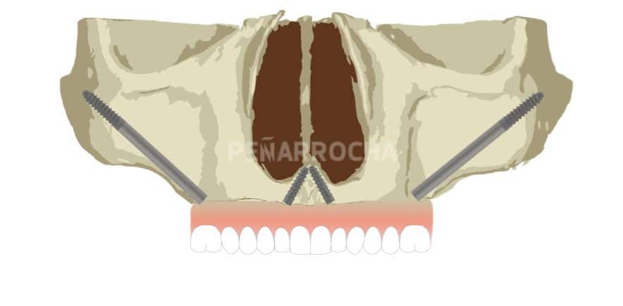 implantes-cigomaticos-2-tratamiento-implantes-sin-hueso-idim-clinica-de-implantes-dentales-en-valencia implantes cigomaticos 2 tratamiento implantes sin hueso idim clinica de implantes dentales en valencia