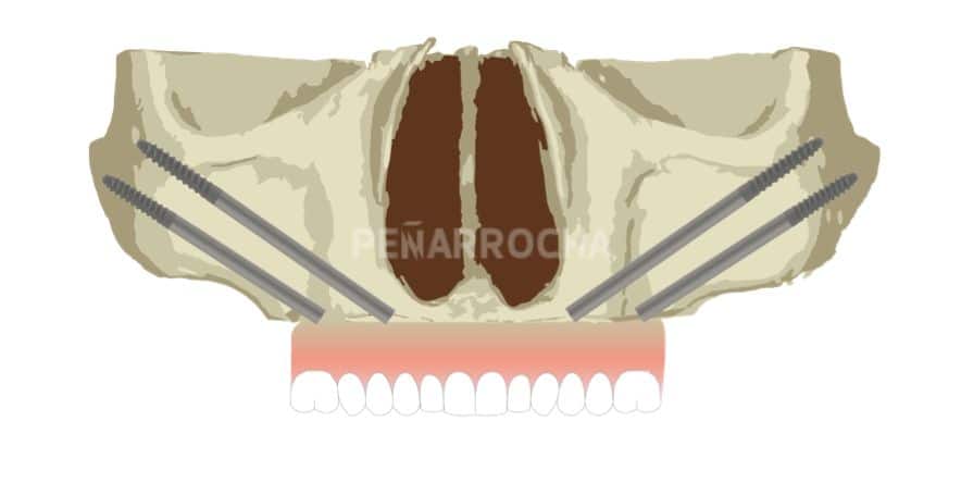implantes-cigomaticos-3-tratamiento-implantes-sin-hueso-idim-clinica-de-implantes-dentales-en-valencia implantes cigomaticos 3 tratamiento implantes sin hueso idim clinica de implantes dentales en valencia