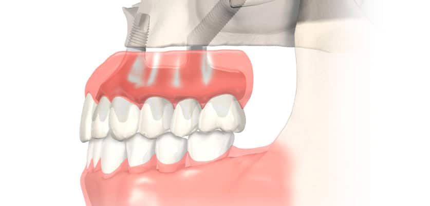 implantes cigomaticos en valencia idim clinica de implantes dentales en valencia