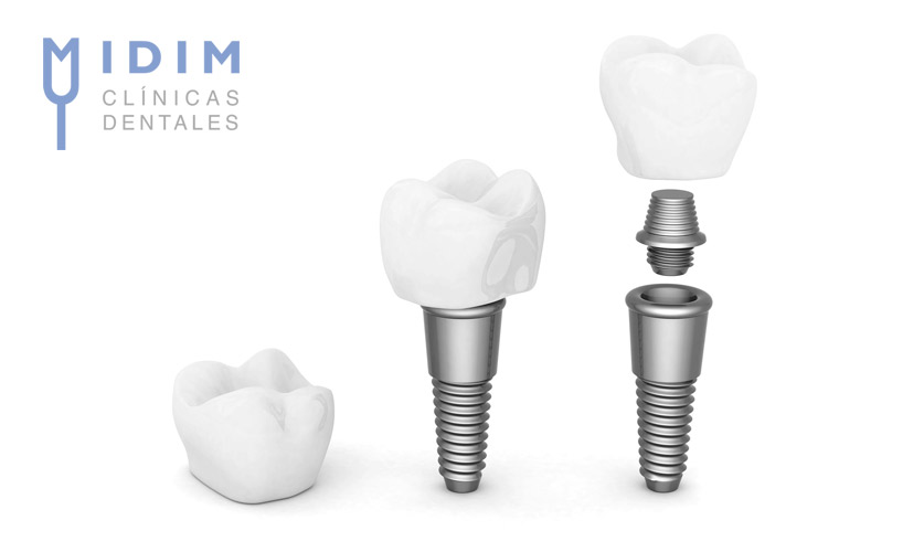 Dental implants