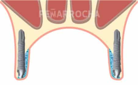 implantes palatinizados 2 tratamiento implantes sin hueso idim clinica de implantes dentales en valencia implantes palatinizados 2 tratamiento implantes sin hueso idim clinica de implantes dentales en valencia