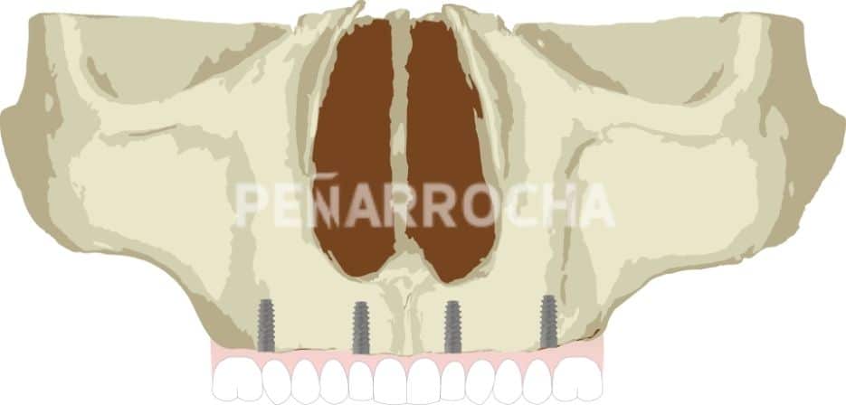 implantes palatinizados tratamiento implantes sin hueso idim clinica de implantes dentales en valencia implantes palatinizados tratamiento implantes sin hueso idim clinica de implantes dentales en valencia