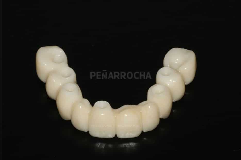Implantes para protesis fijas en arcada completa implantes en un dia IDIM clinica de implantes dentales en valencia