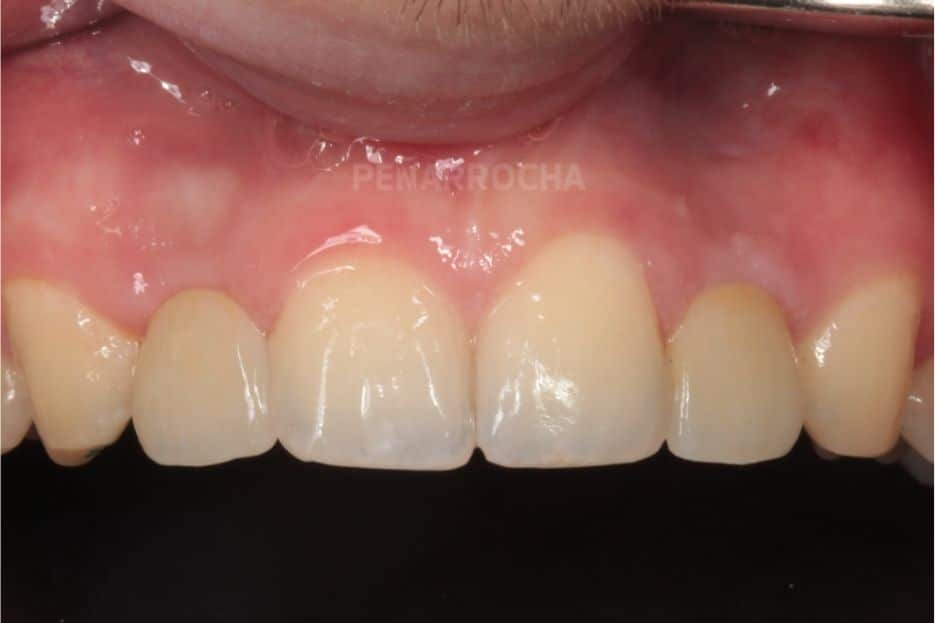 implantes parciales definitivos implantes en un dia IDIM clinica de implantes dentales en valencia