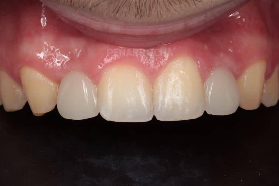 implantes parciales provisionales implantes en un dia IDIM clinica de implantes dentales en valencia