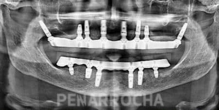 implantes-pterigoideos-tratamiento-implantes-sin-hueso-idim-clinica-de-implantes-dentales-en-valencia implantes pterigoideos tratamiento implantes sin hueso idim clinica de implantes dentales en valencia