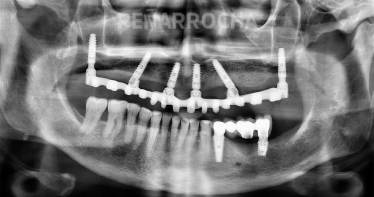 implantes-pterigoideos2-tratamiento-implantes-sin-hueso-idim-clinica-de-implantes-dentales-en-valencia implantes pterigoideos2 tratamiento implantes sin hueso idim clinica de implantes dentales en valencia