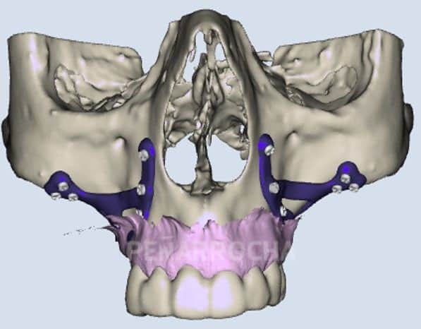implantes subperiosticos tratamiento implantes dentales sin tornillos idim clinica de implantes dentales en valencia