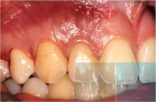 inflamacion sintoma endodoncia mal hecha idim clinica de implantes dentales en valencia 