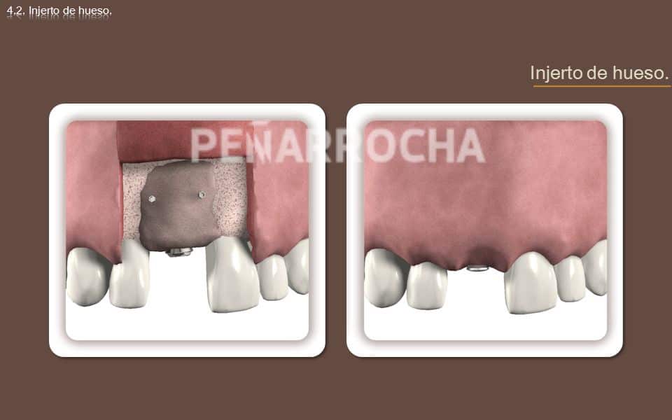 injerto-de-hueso-tratamiento-implantes-sin-hueso-IDIM-clinica-de-implantes-dentales-en-valencia injerto de hueso tratamiento implantes sin hueso IDIM clinica de implantes dentales en valencia