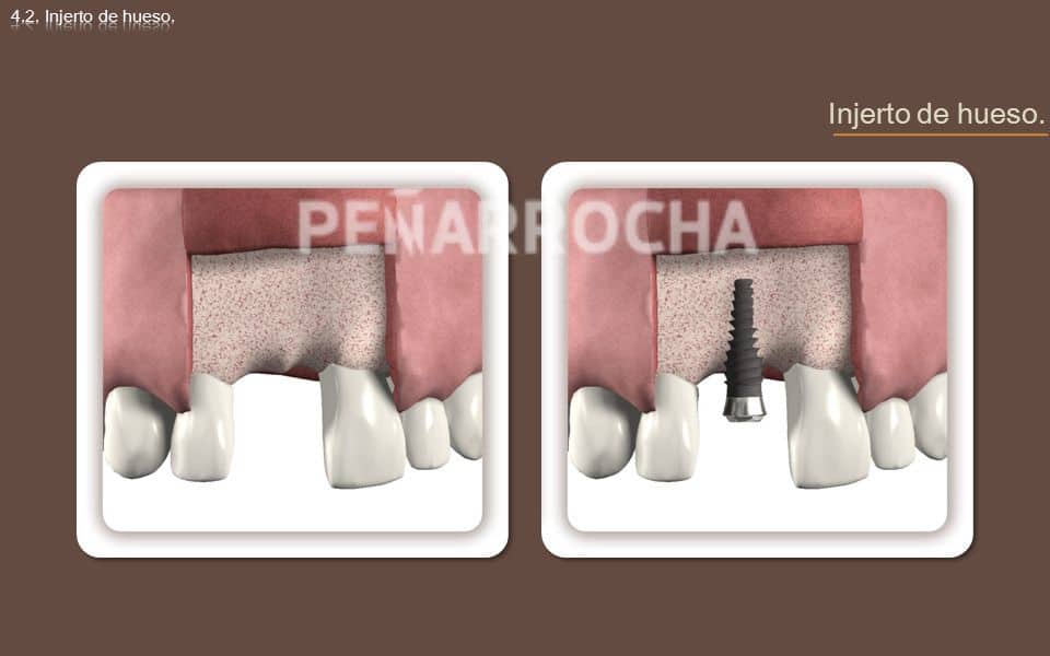 injerto oseo tratamiento implantes sin hueso idim clinica de implantes dentales en valencia injerto oseo tratamiento implantes sin hueso idim clinica de implantes dentales en valencia